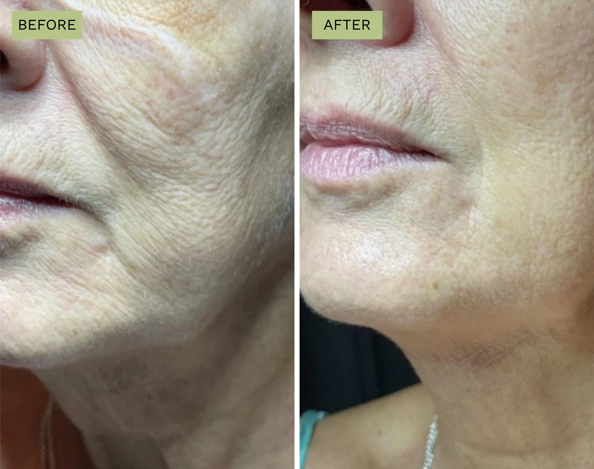 Cheek and Jawline Lift with PDO Threads
