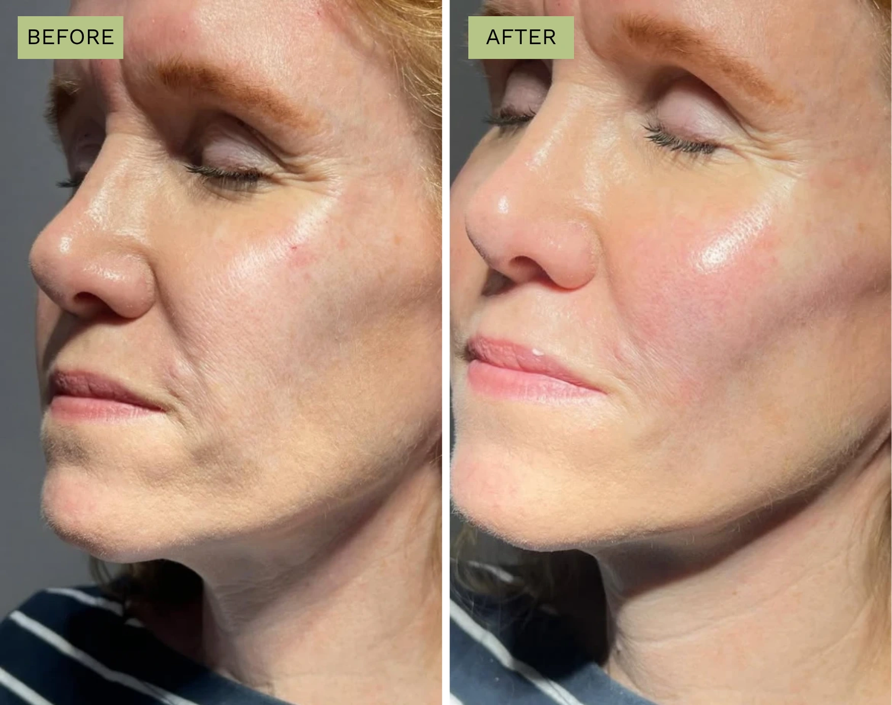 Elite Cheeks – Melanie Hartsell, APRN-C