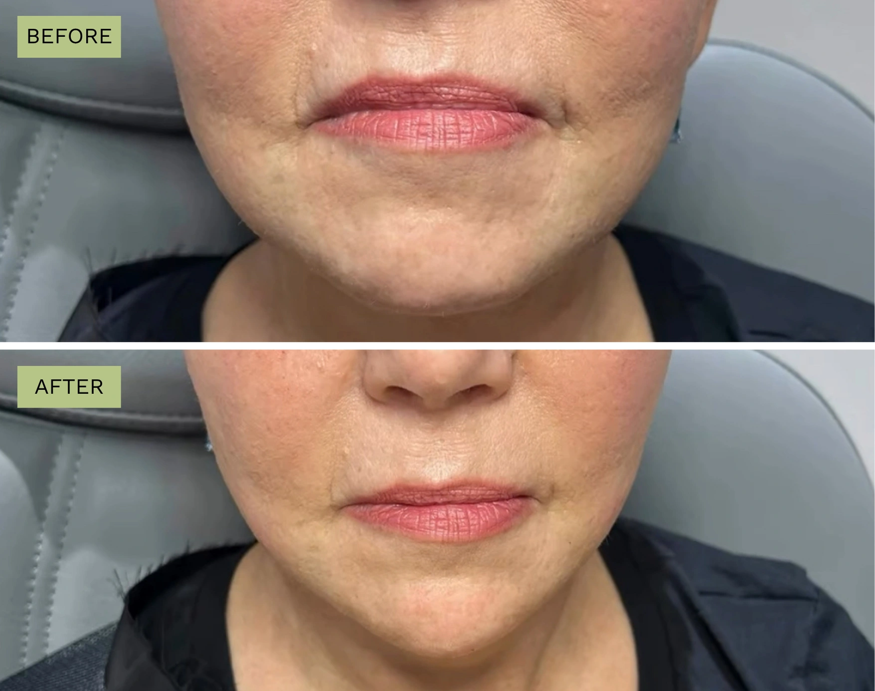 Elite Jawline and Elite Chin with Radiesse - Jeff Goldstein, PA-C