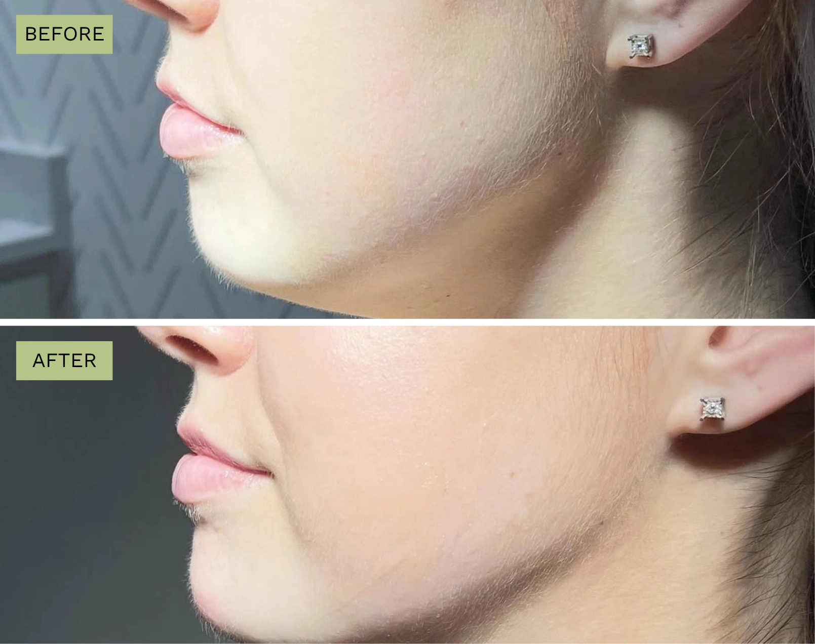 Chin Radiesse - Before and After Elite Medical Spa
