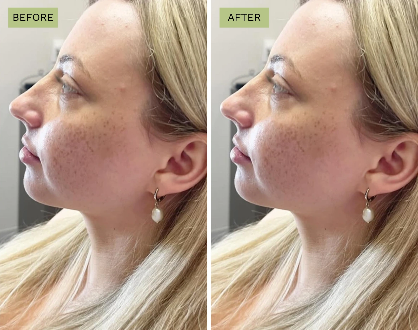 Elite Chin Radiesse - Before and After Elite Medical Spa