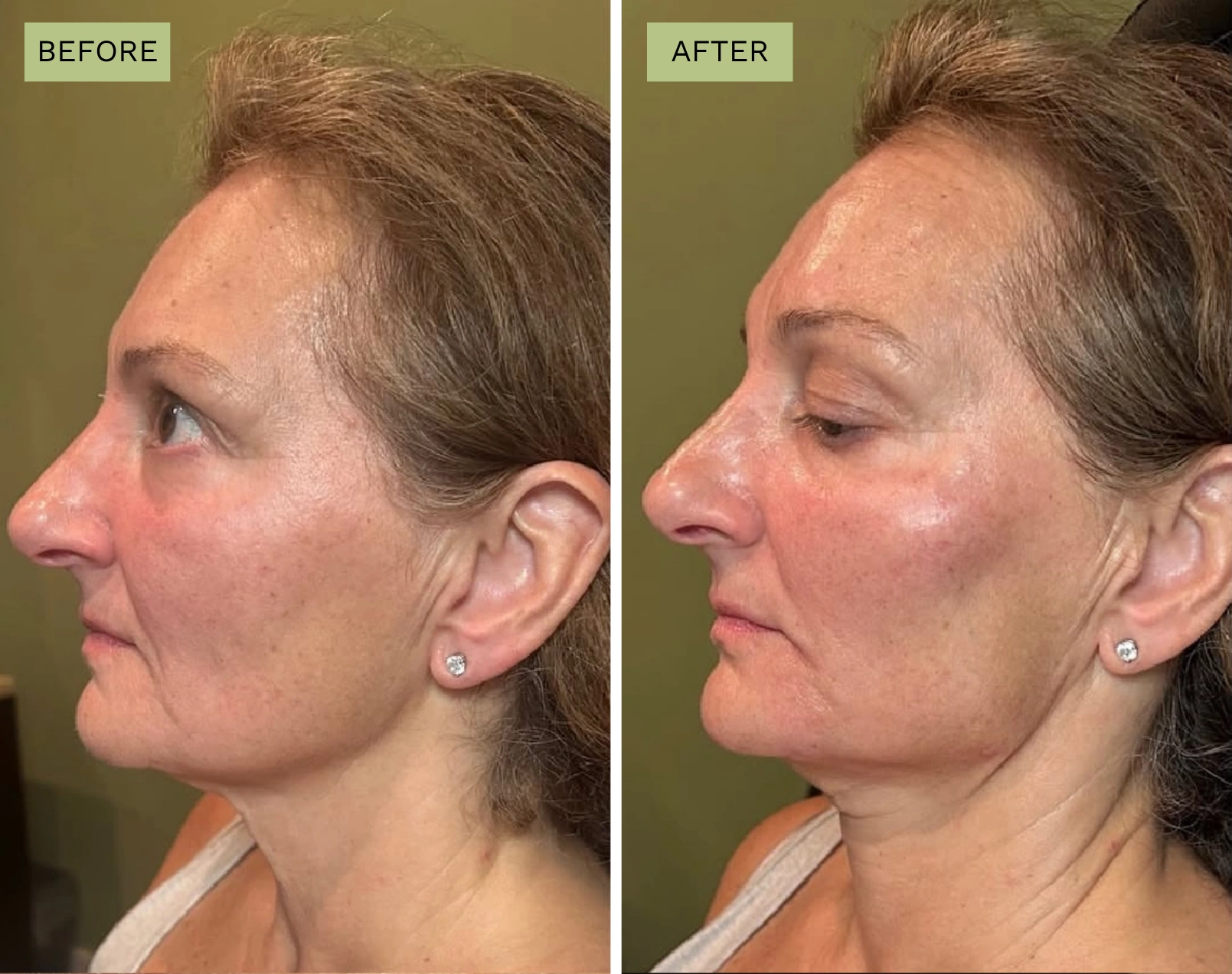 Elite Jawline – Jeff Goldstein, PA-C