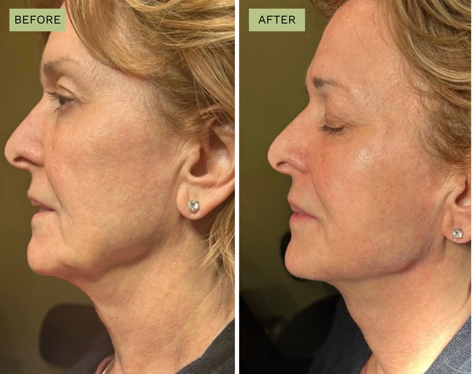 Elite Jawline – Jeff Goldstein, PA-C