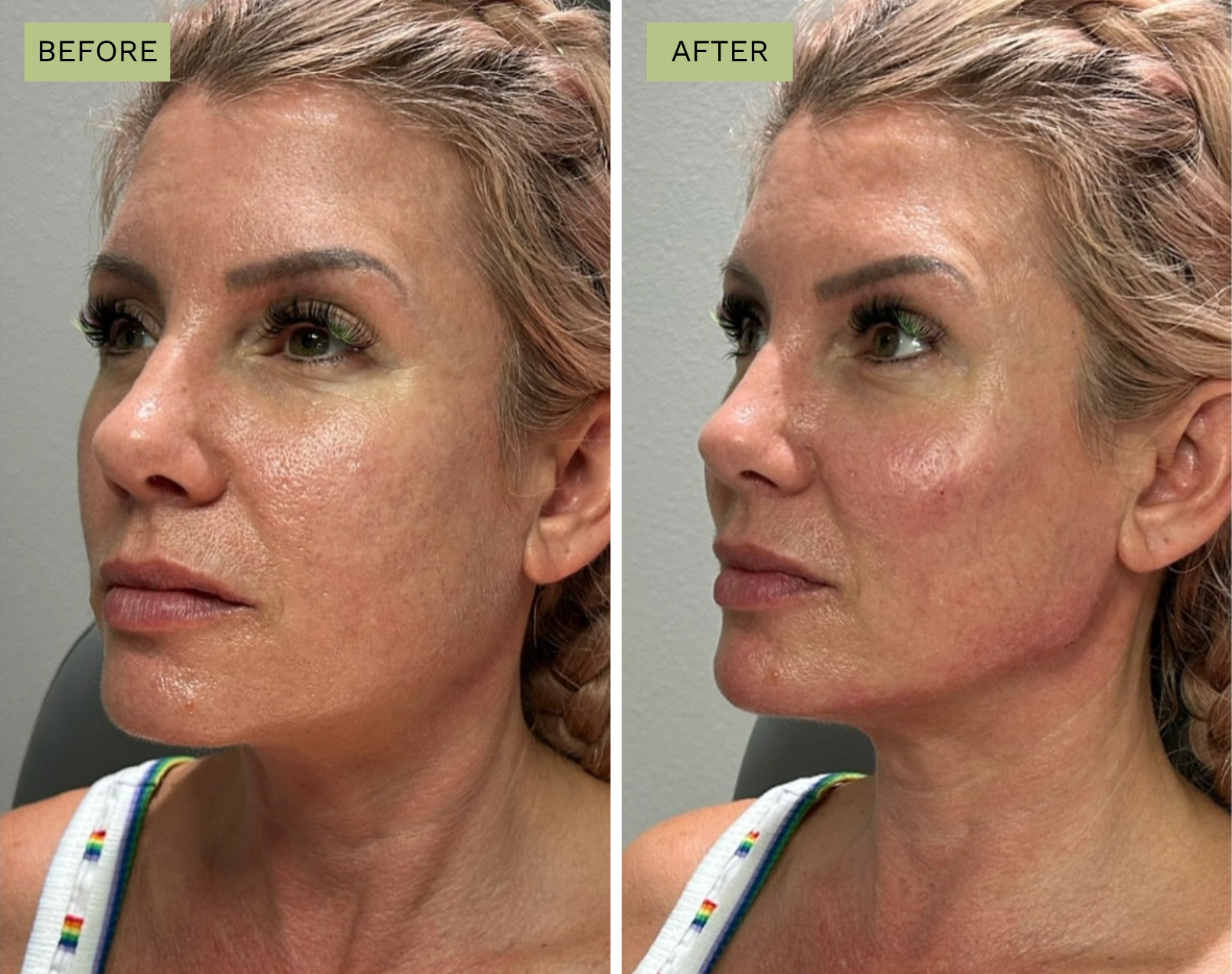 Elite Jawline – Jeff Goldstein, PA-C