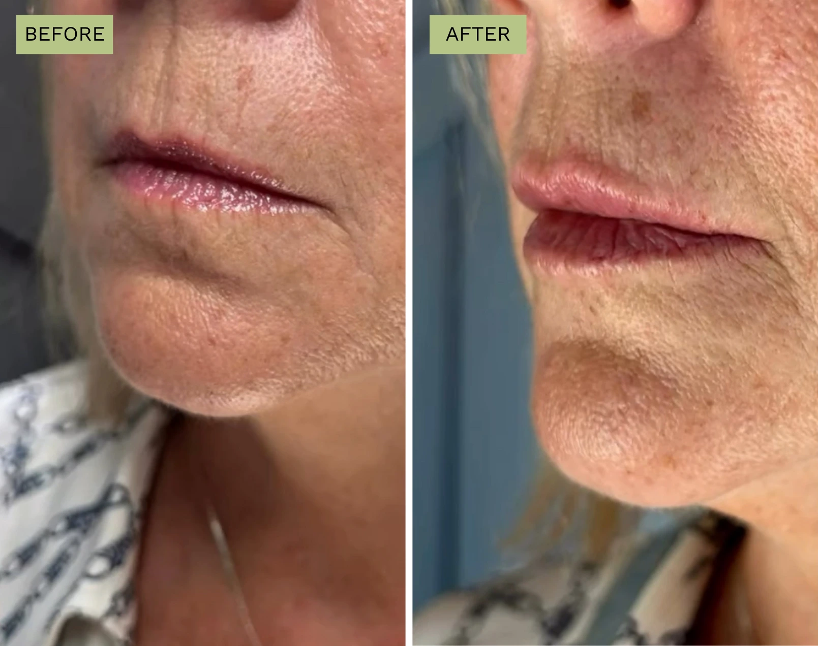 Elite Under Lip Filler with Juvederm - Jeff Goldstein, PA-C