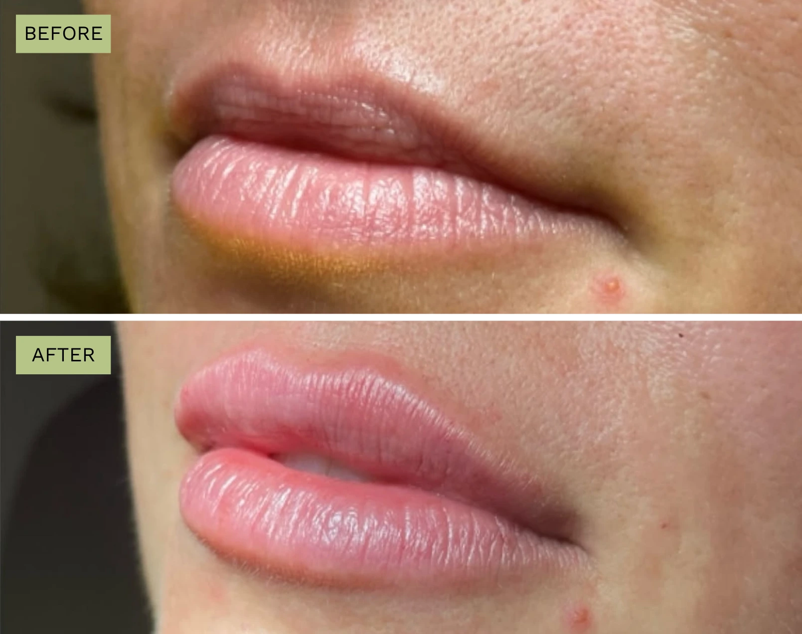 Juvederm Elite Medical Spa Sarasota
