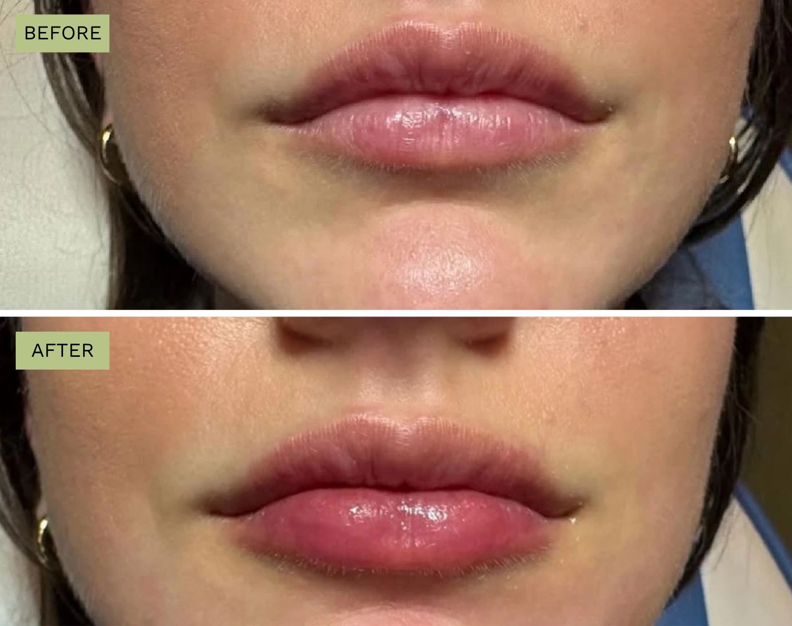 Lips Juvederm - Before and After Elite Medical Spa Sarasota