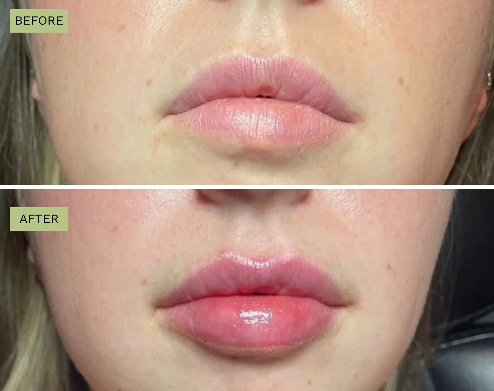 Lips Juvederm - Before and After Elite Medical Spa Sarasota