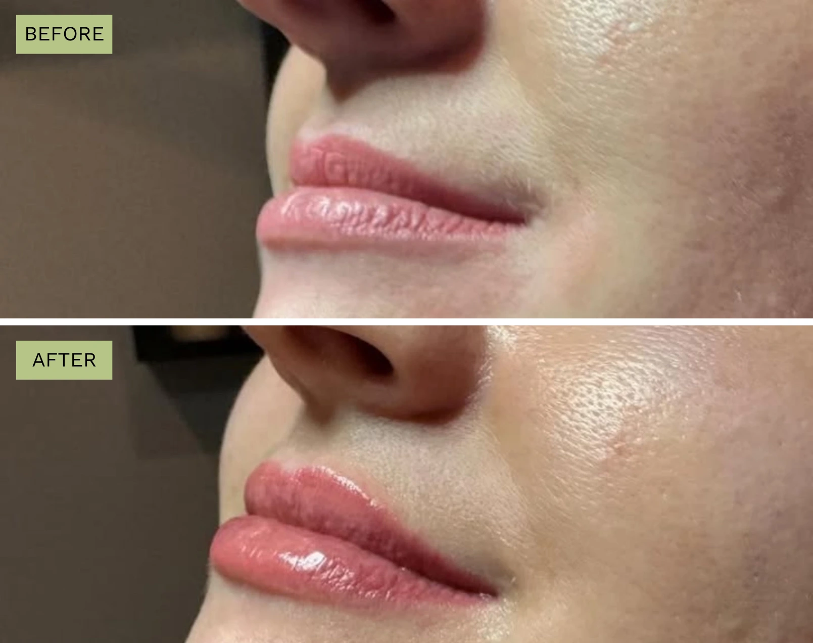 Lips Juvederm - Before and After Elite Medical Spa Sarasota