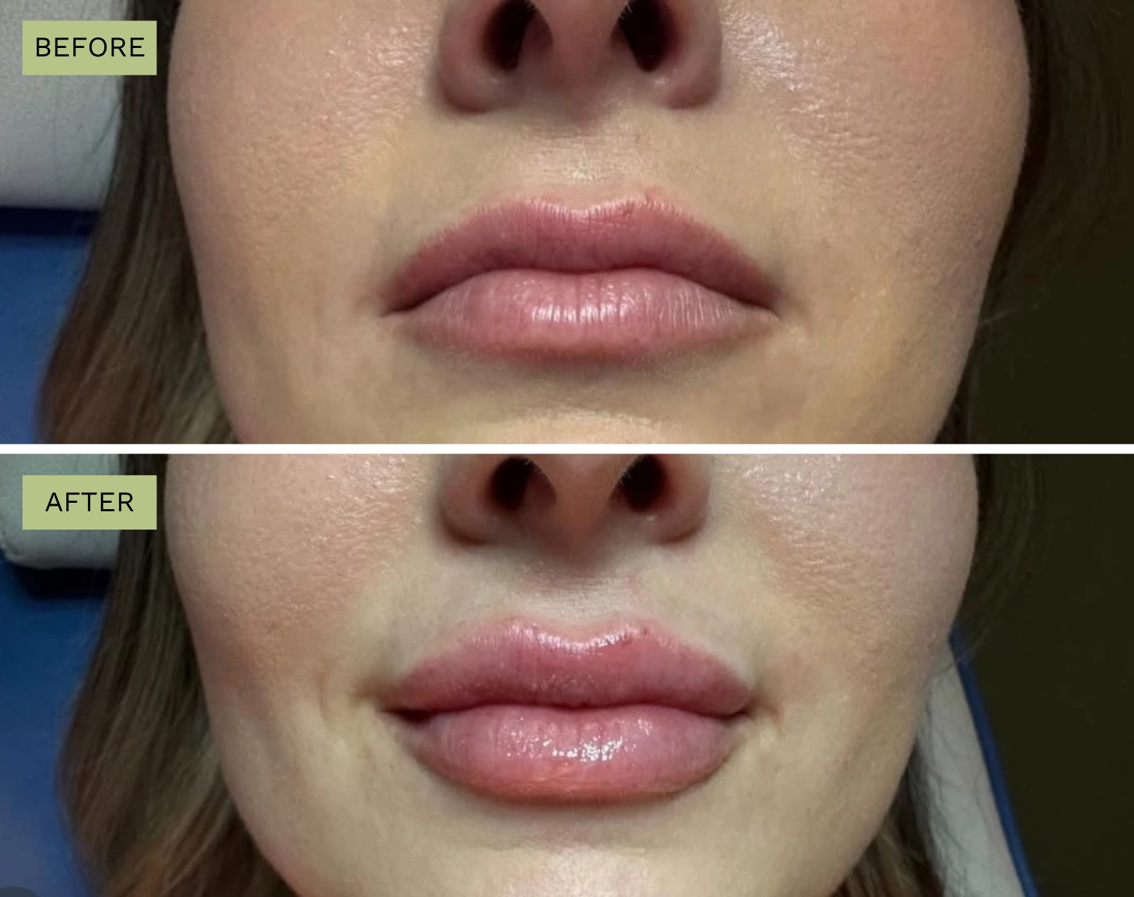 Lips Juvederm Treatment Before and After - Elite Medical Spa