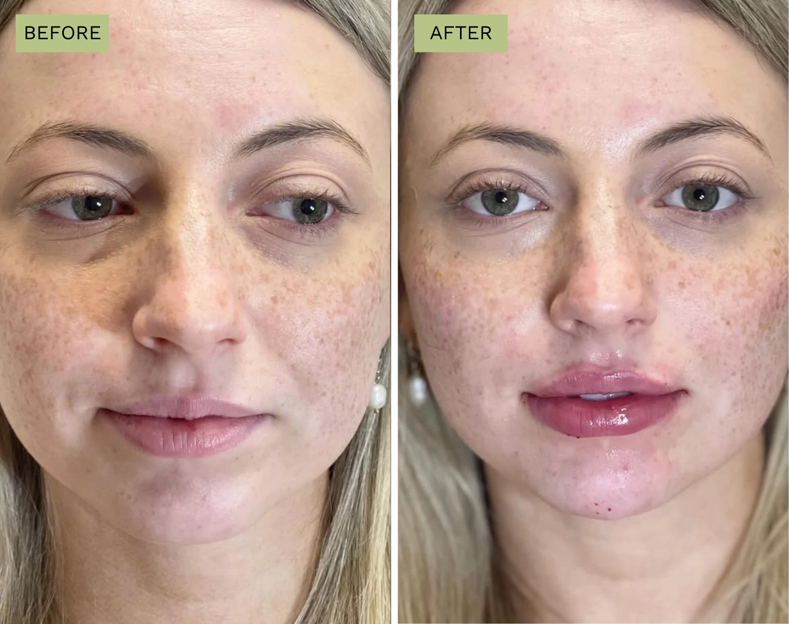 Lips Juvederm - Before and After Elite Medical Spa Sarasota