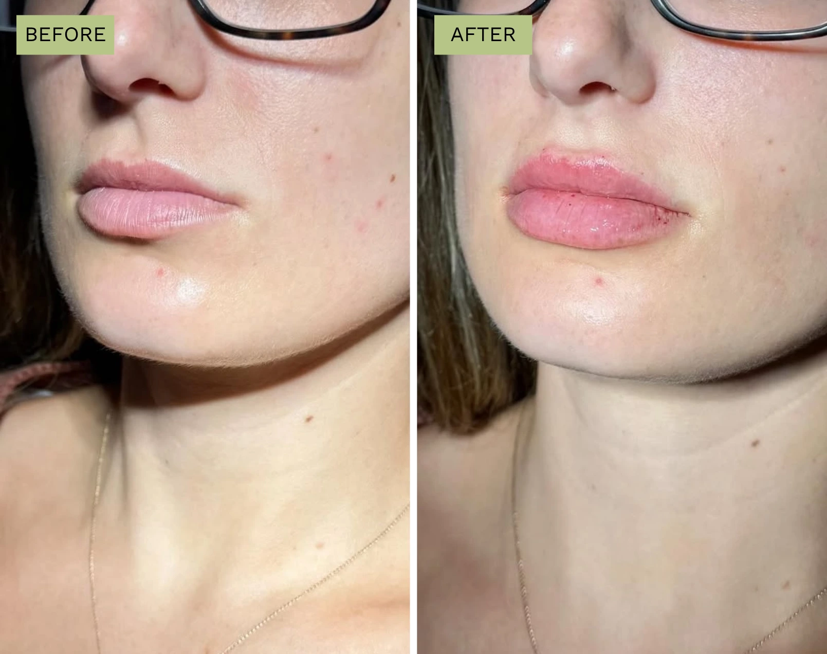 Lips Juvederm Treatment Before and After - Elite Medical Spa