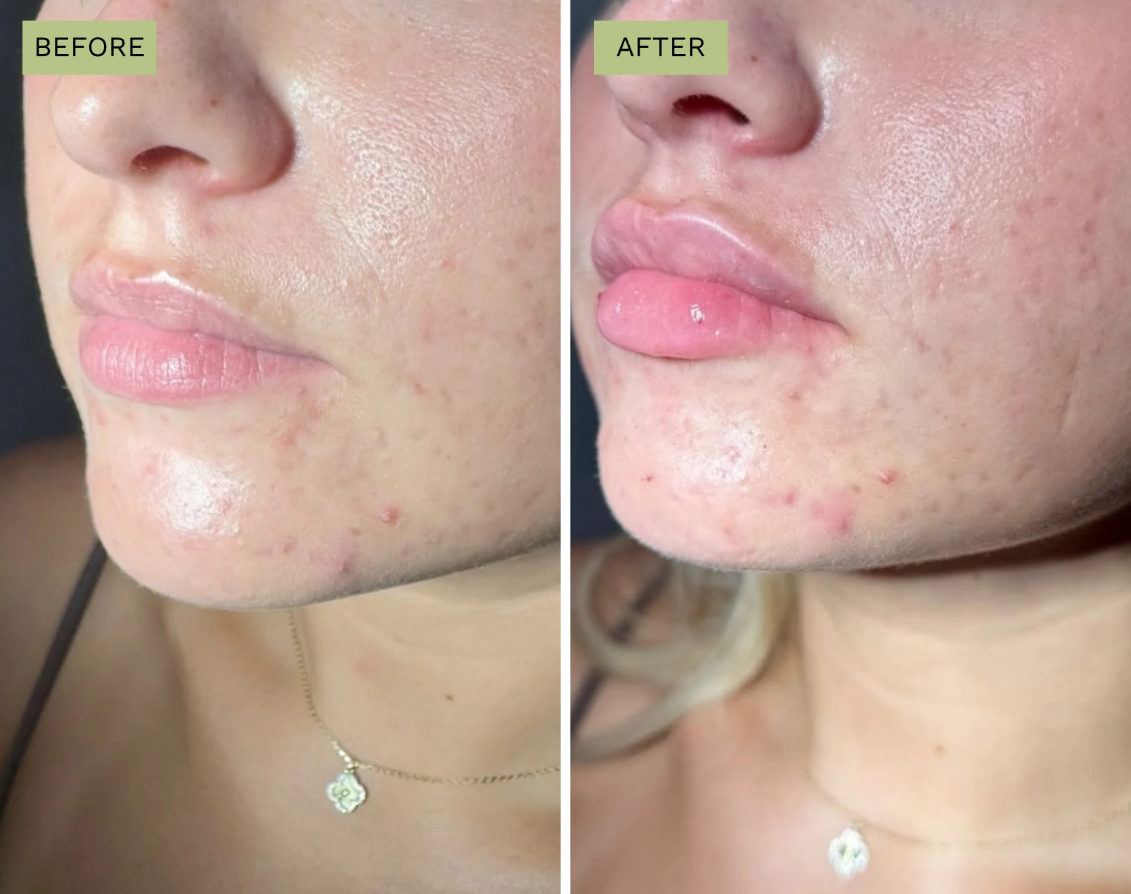 Elite Lips Filler with Juvederm - Melanie Hartsell, APRN-C