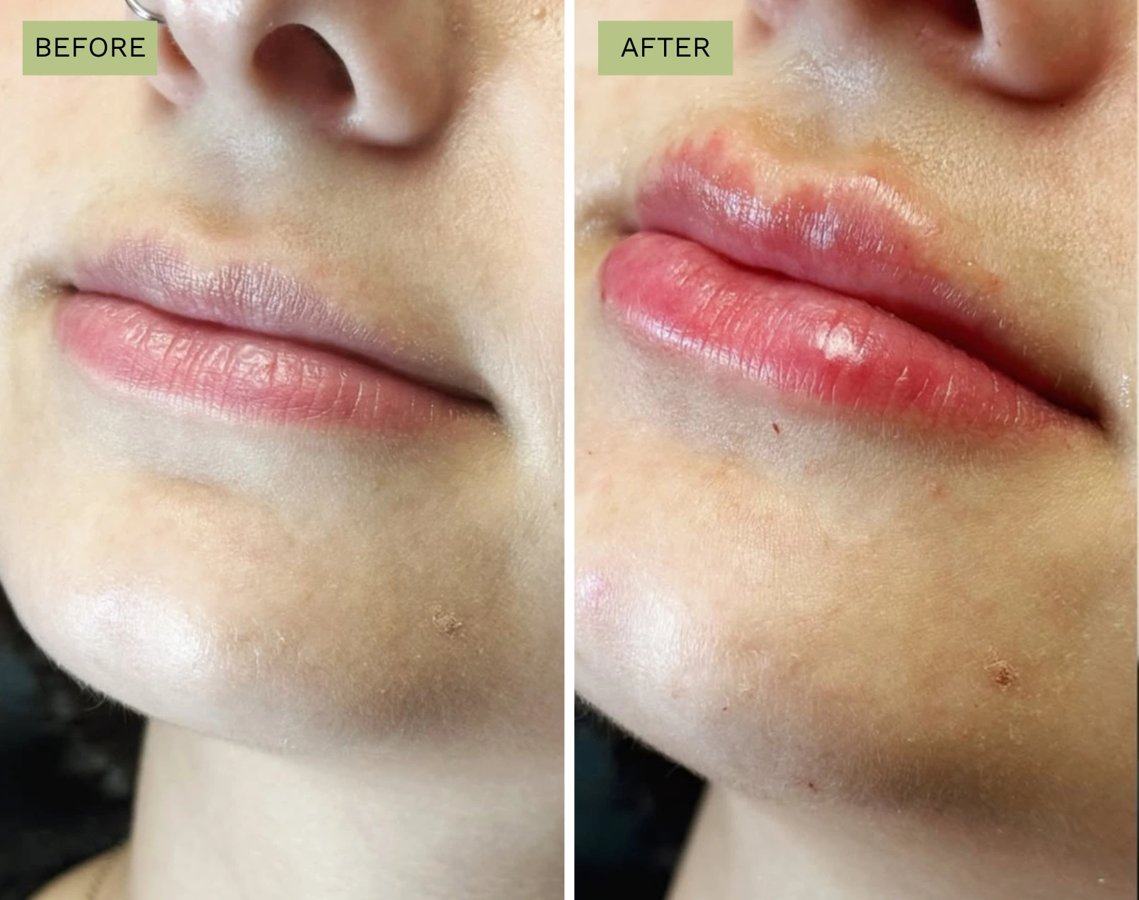 Elite Lips – Melanie Hartsell, APRN-C