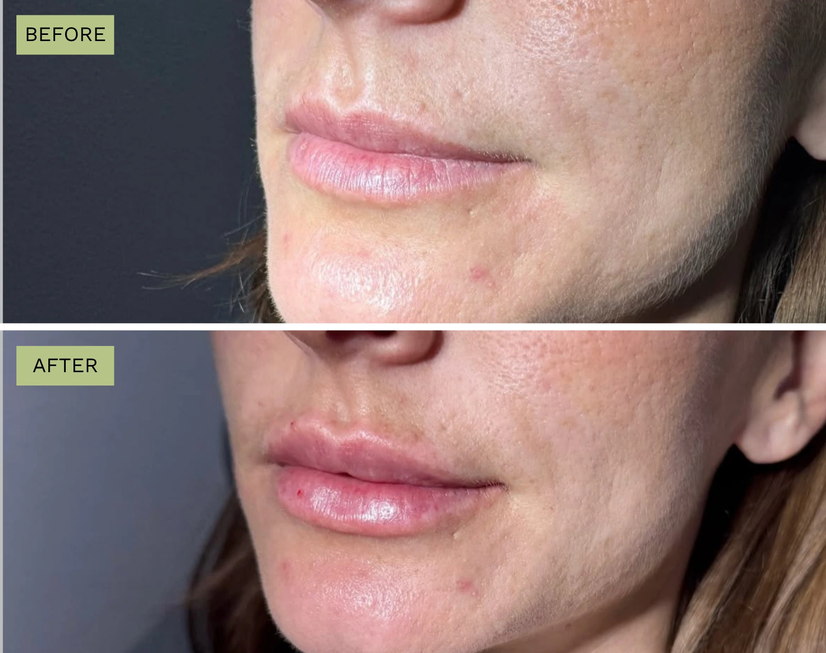 Elite Lips – Melanie Hartsell, APRN-C