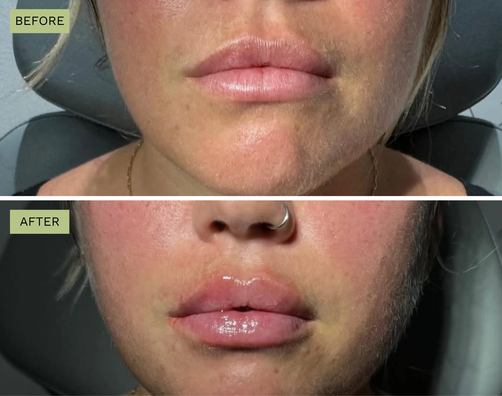 Elite Lips – Melanie Hartsell, APRN-C