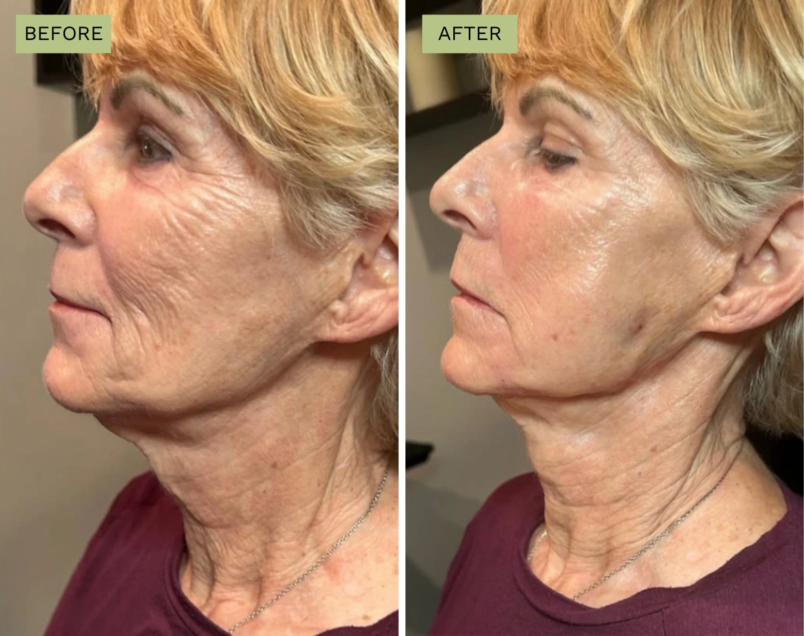 Elite Liquid Facelift – Jeff Goldstein, PA-C