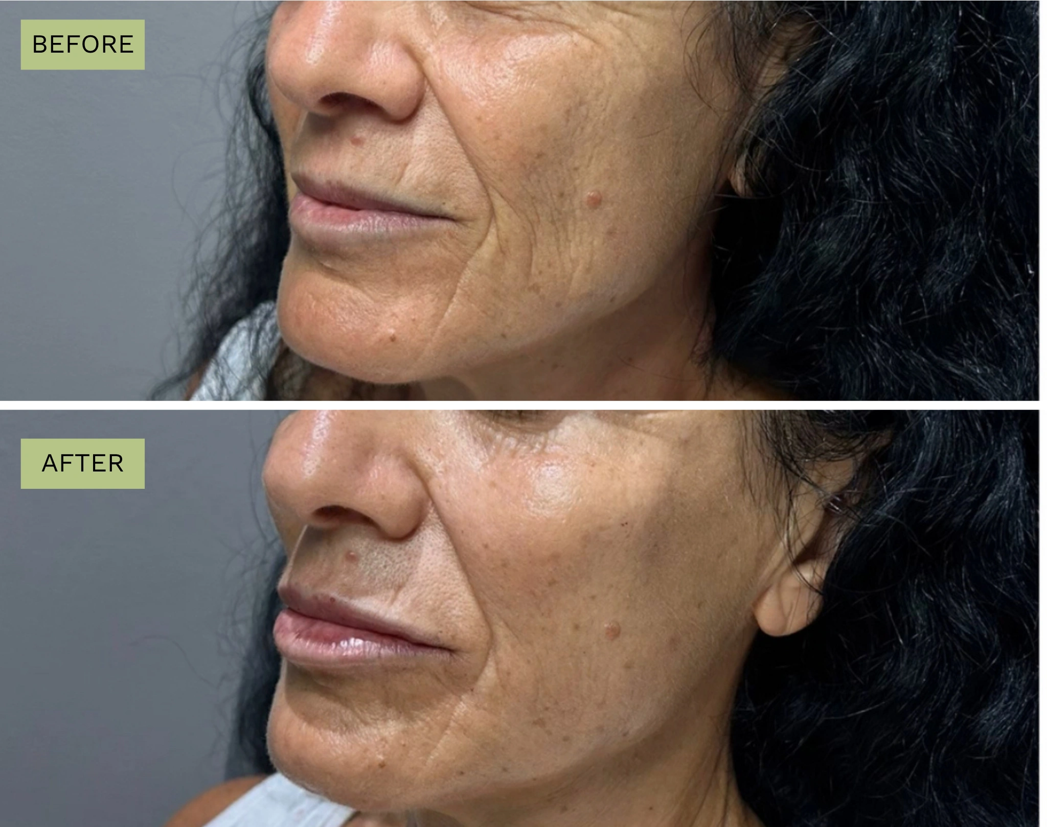 Elite Liquid Facelift – Jeff Goldstein, PA-C