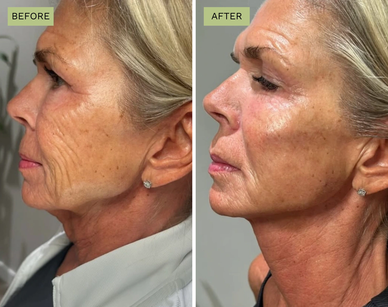 Elite Liquid Facelift – Jeff Goldstein, PA-C