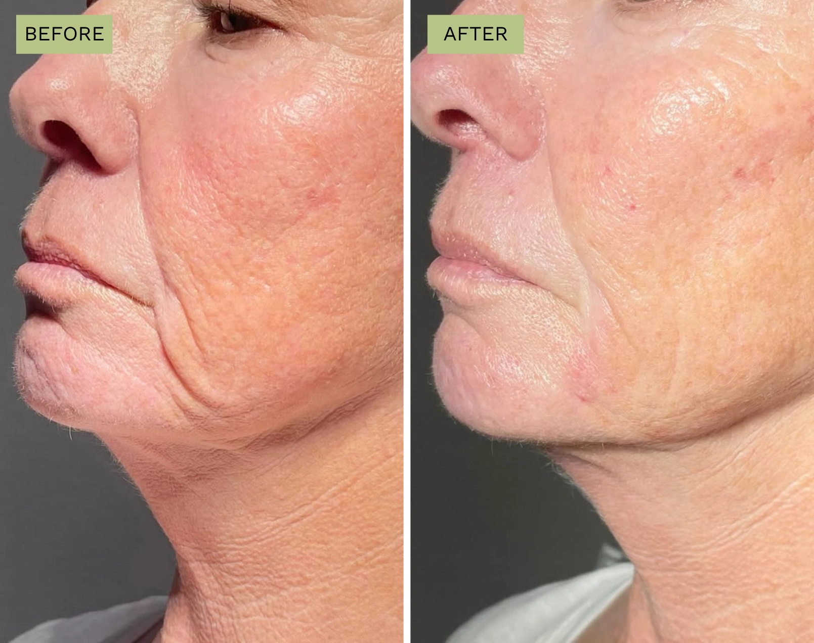 Elite Liquid Facelift – Melanie Hartsell, APRN-C