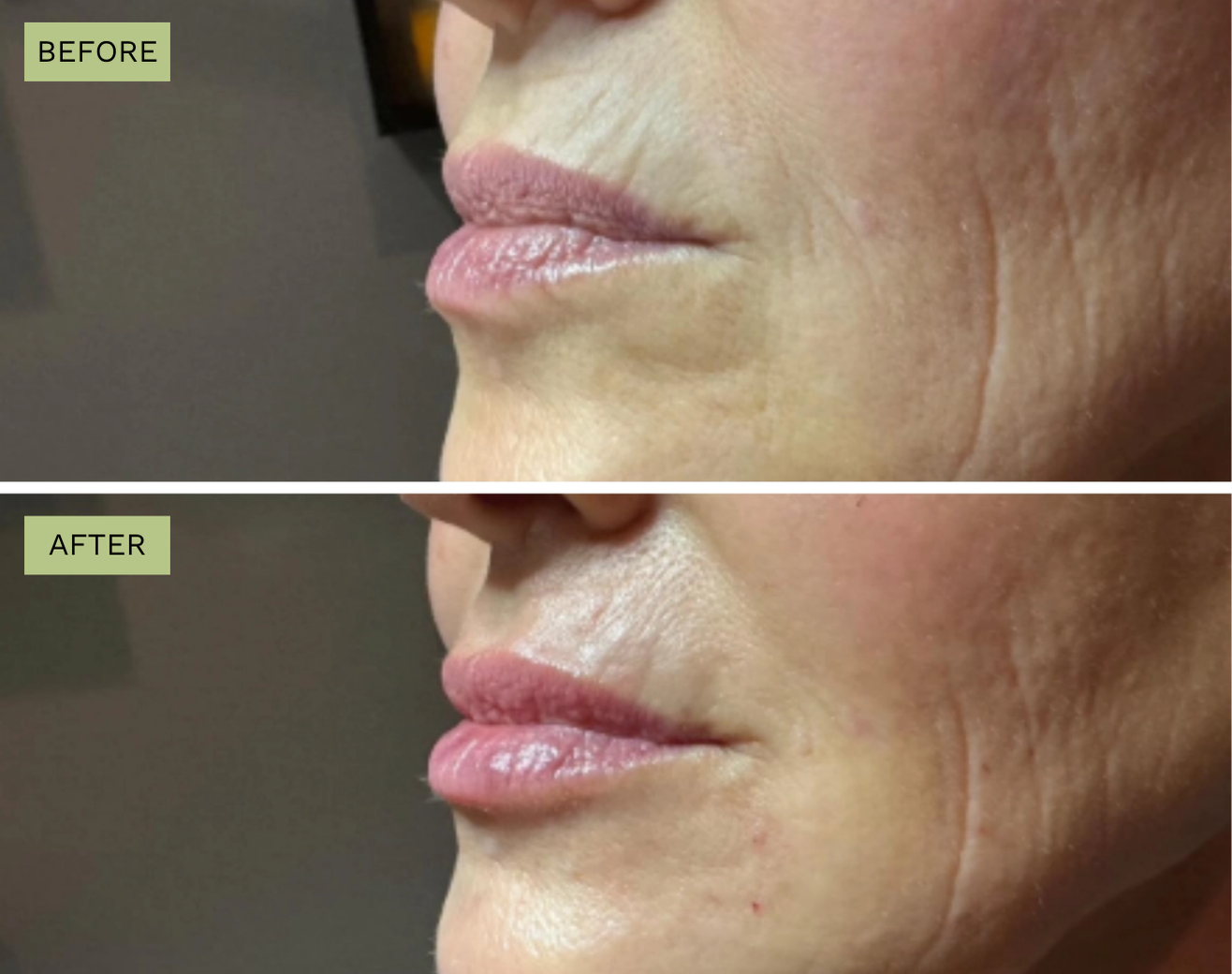 Smoker Lines Treatment Juvederm - Before and After Elite Medical Spa Sarasota