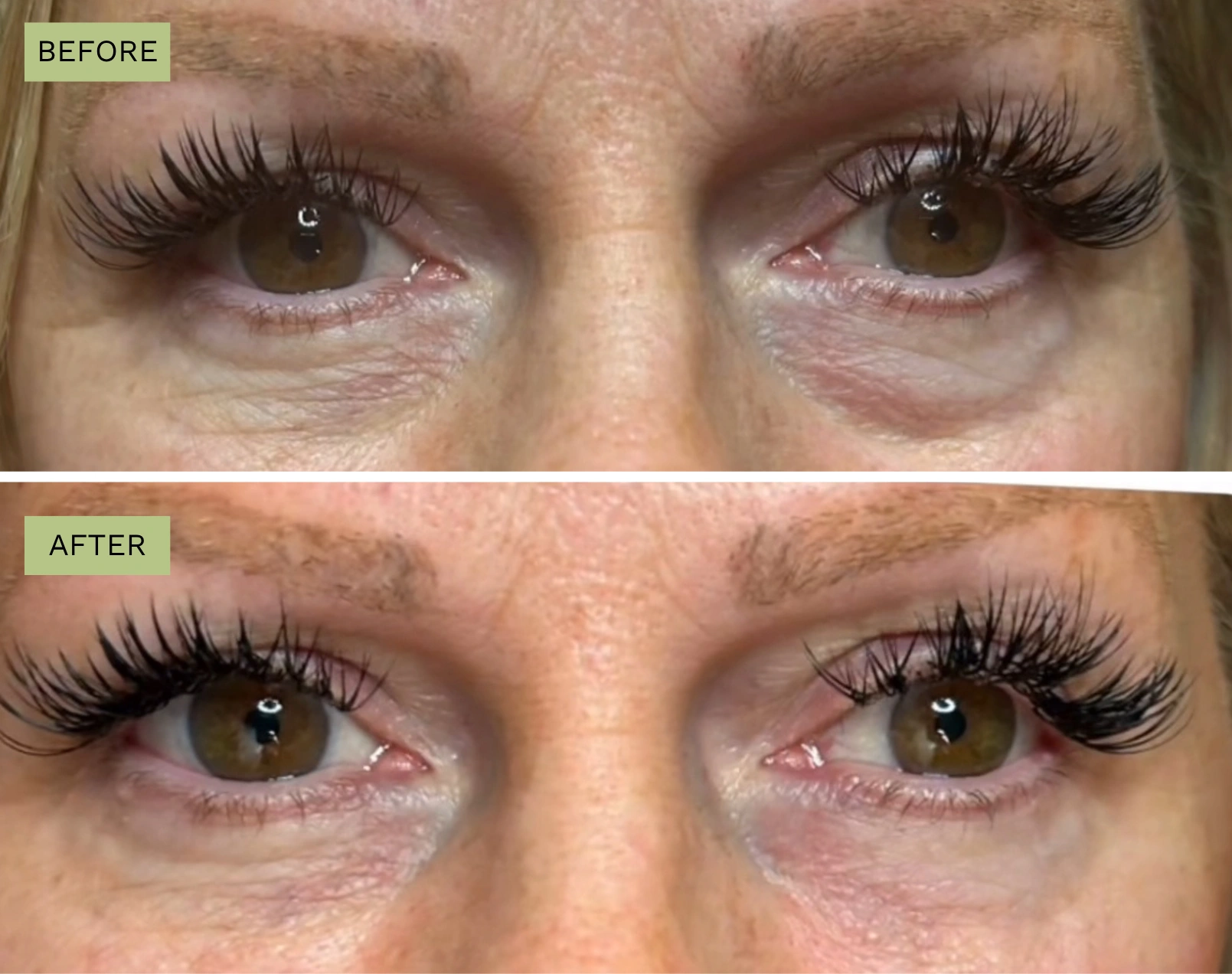 Elite Under Eyes – Jeff Goldstein, PA-C