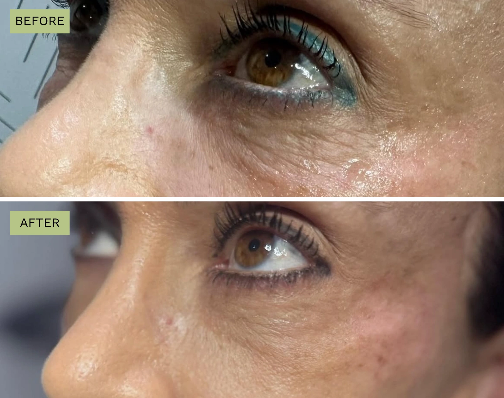 Elite Under Eyes – Melanie Hartsell, APRN-C