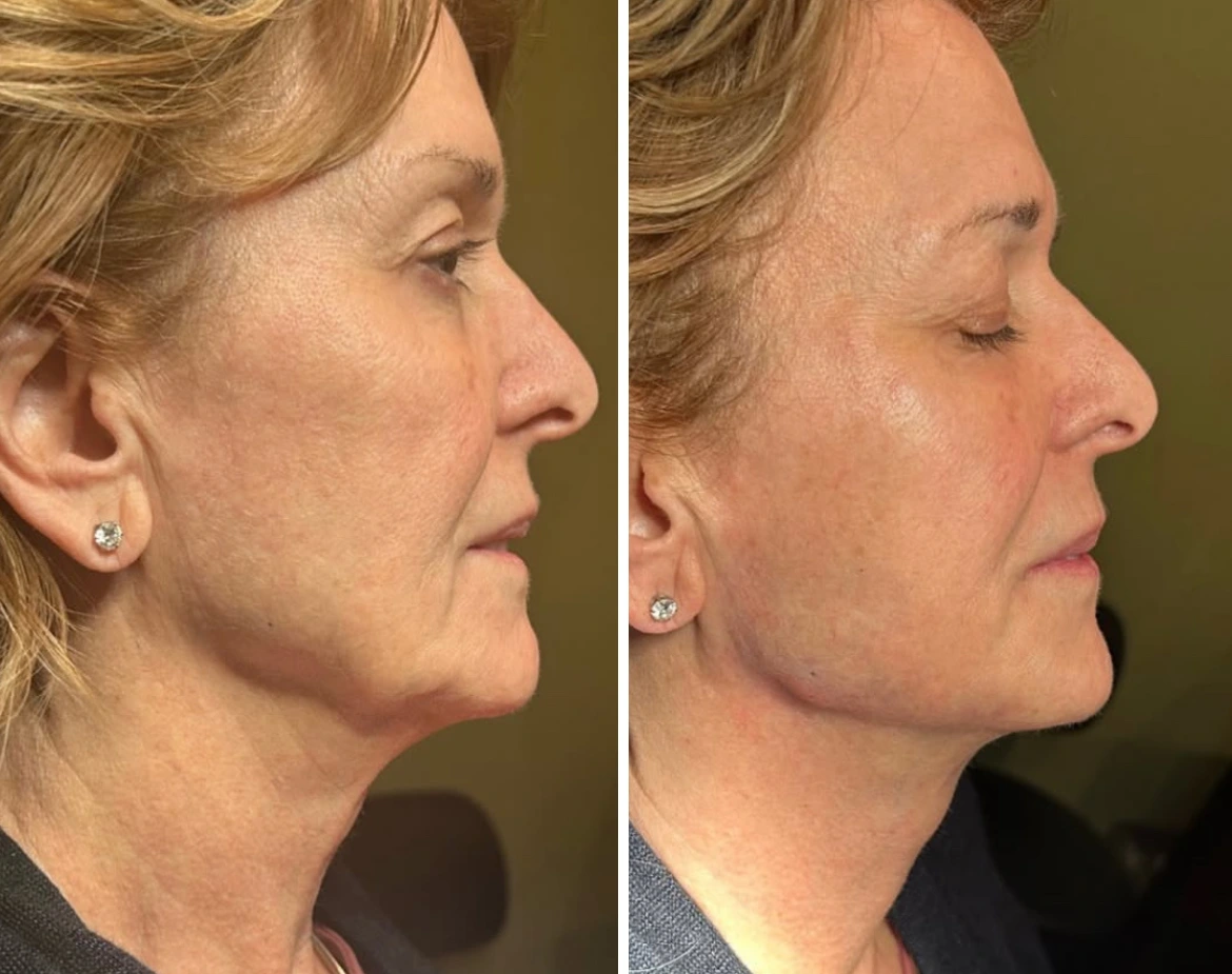 EliteJawline-JeffGoldstein-five.webp