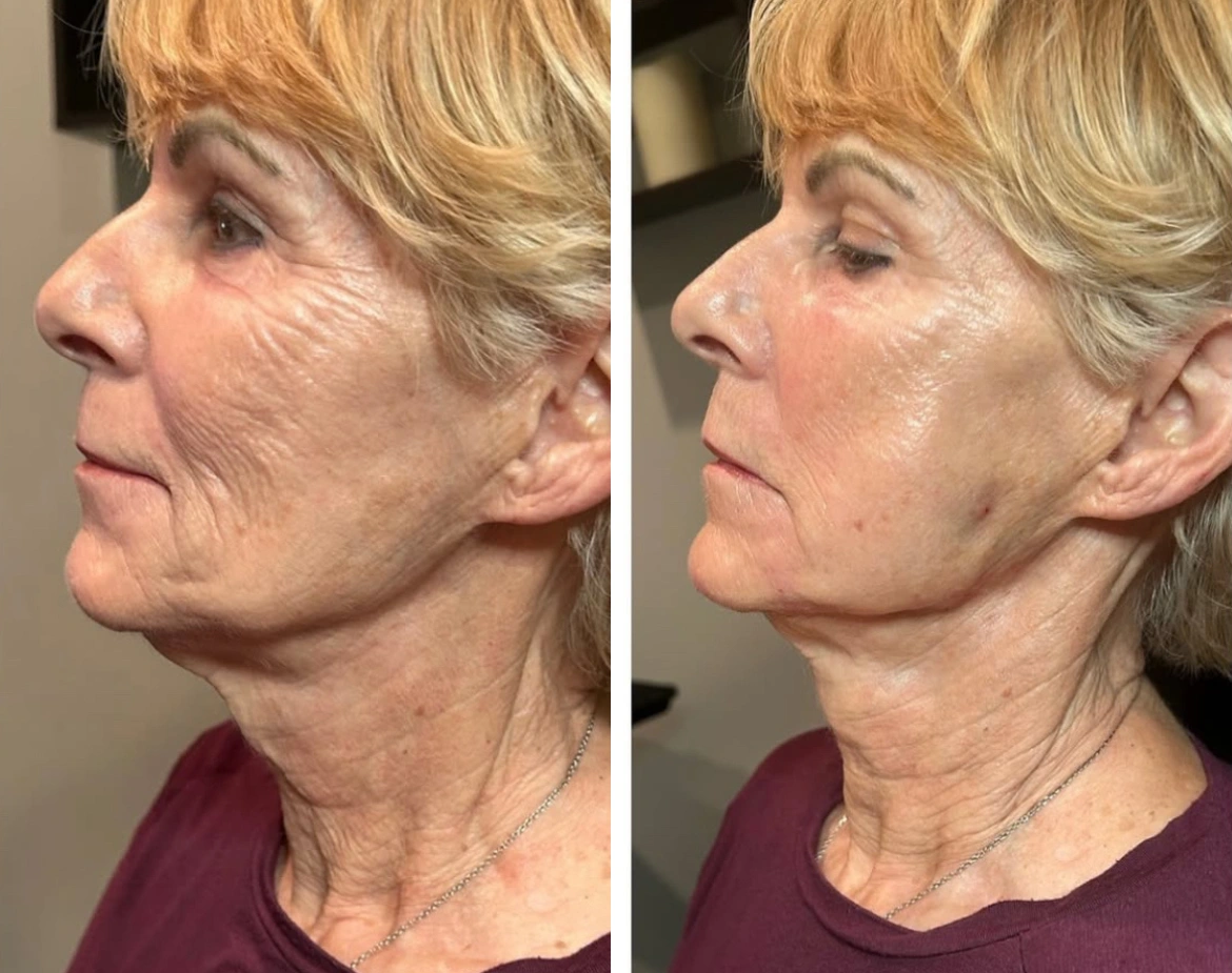 EliteLiquidFacelift-JeffGoldstein-one.webp