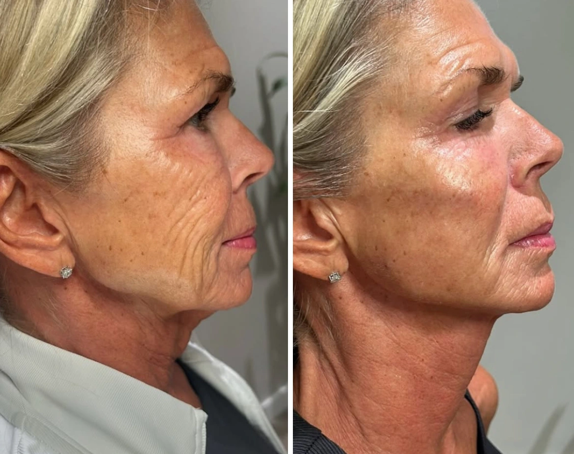 EliteLiquidFacelift-JeffGoldstein-three.webp