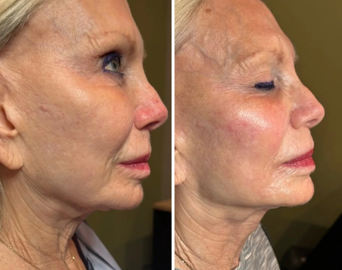 EliteLiquidFacelift-JeffGoldstein-two.webp