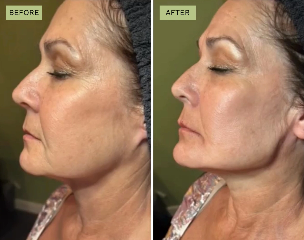 Jawline Lift with PDO Threads