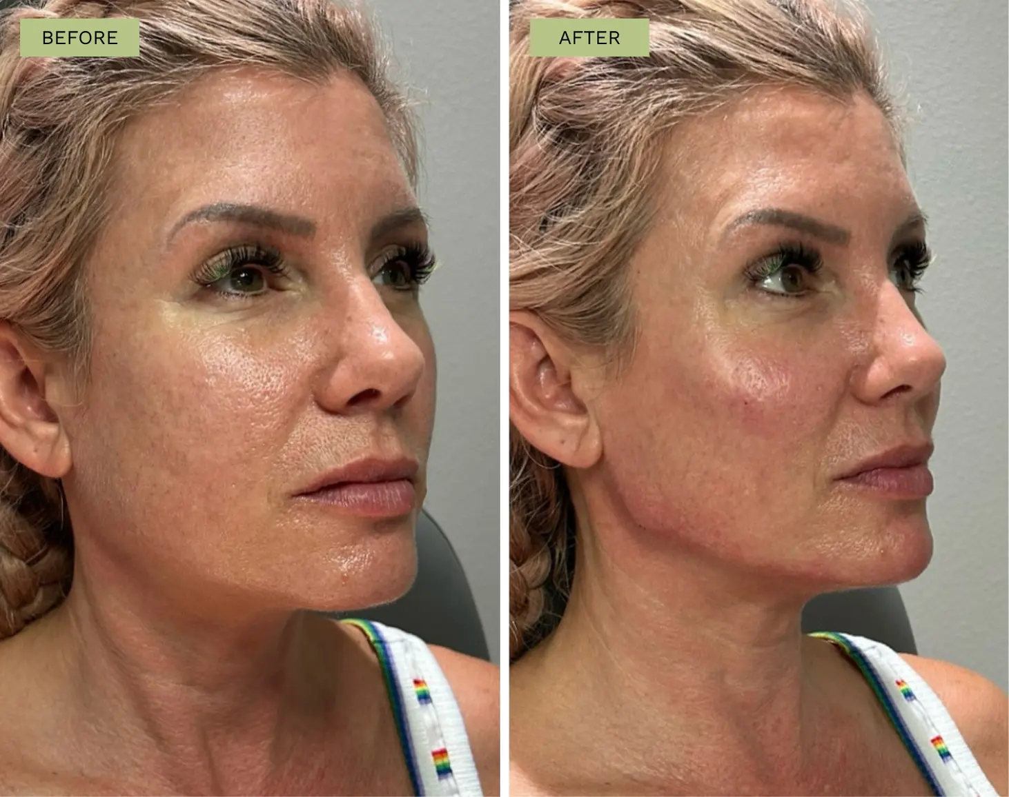 Elite Cheek and Elite Jawline Filler with Radiesse