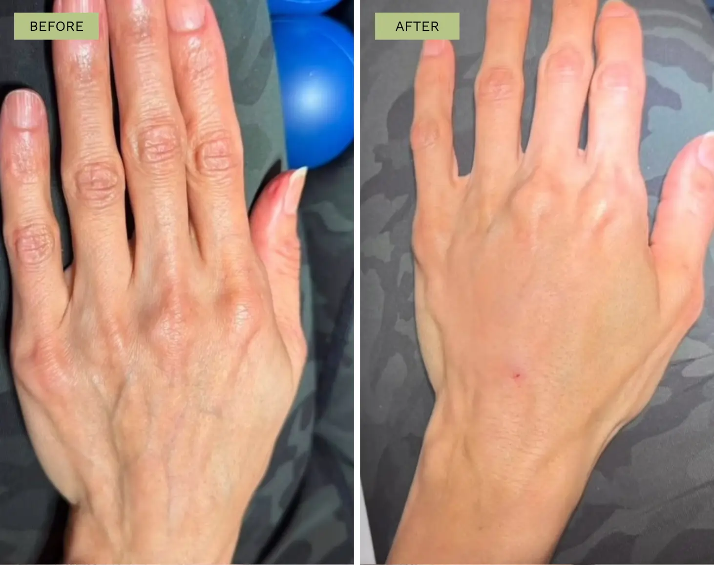 Elite Hand Rejuvenation with Radiesse - Jeff Goldstein, PA-C