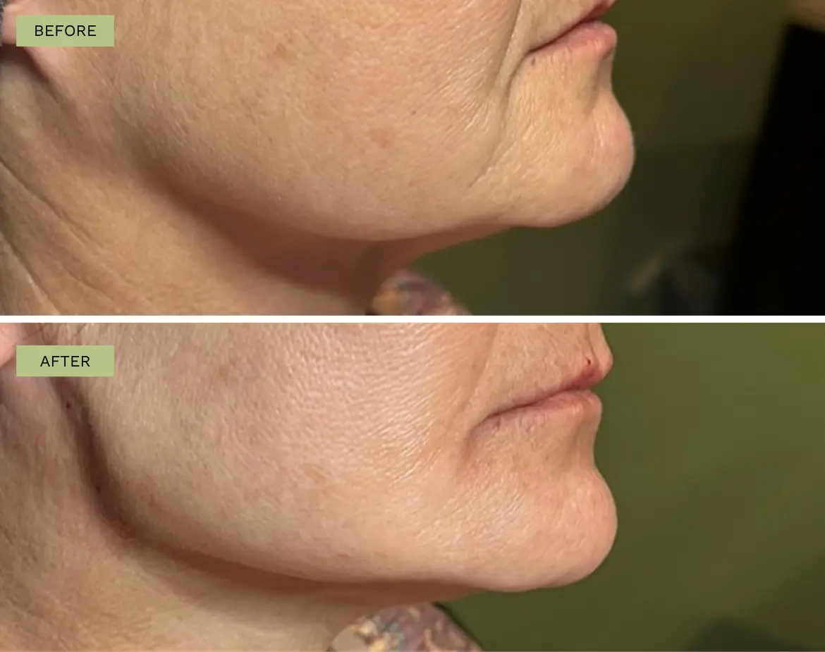 Elite Jawline Filler with Radiesse - Jeff Goldstein, PA-C