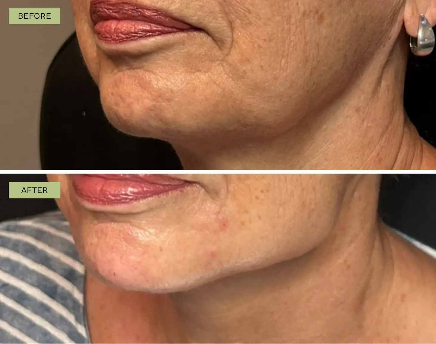 Elite Jawline with Radiesse - Jeff Goldstein, PA-C