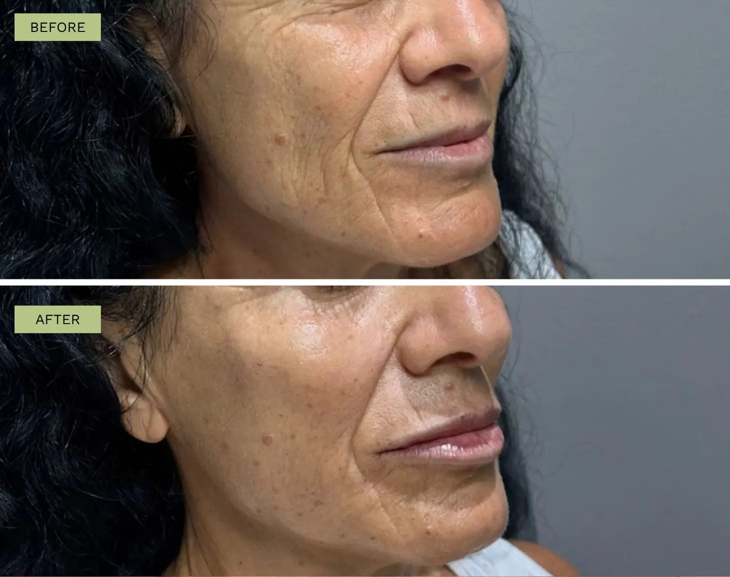 Elite Liquid Facelift - Radiesse in mid face - Jeff Goldstein, PA-C