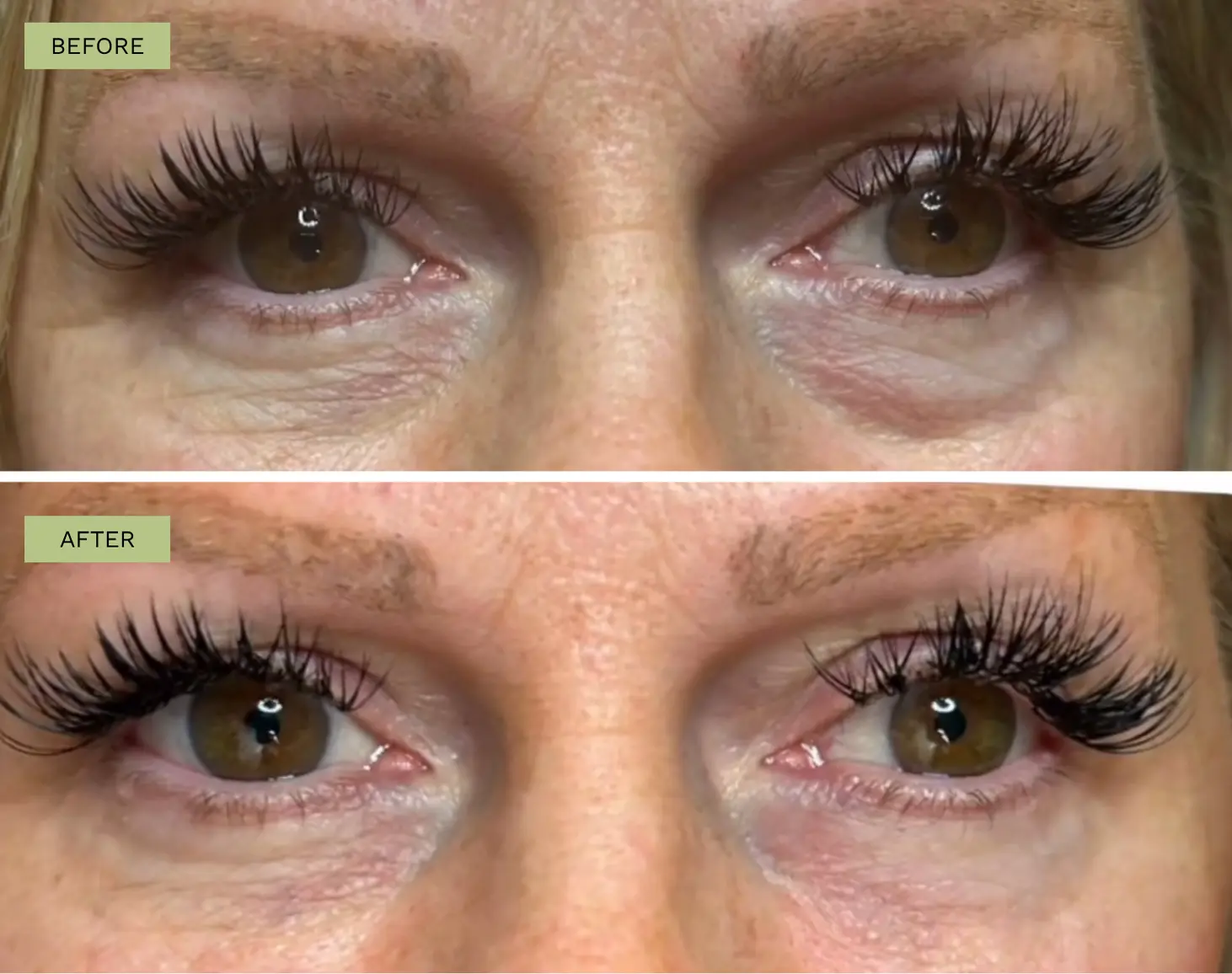 Elite Under Eye Filler with Belotero - Jeff Goldstein, PA-C