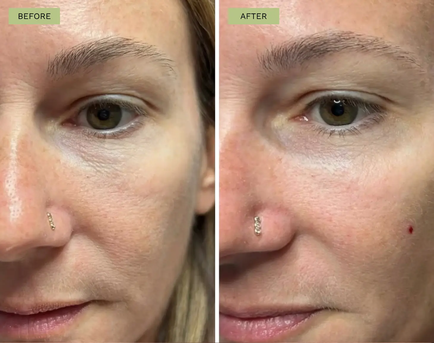 Elite Under Eye Filler with Belotero - Jeff Goldstein, PA-C