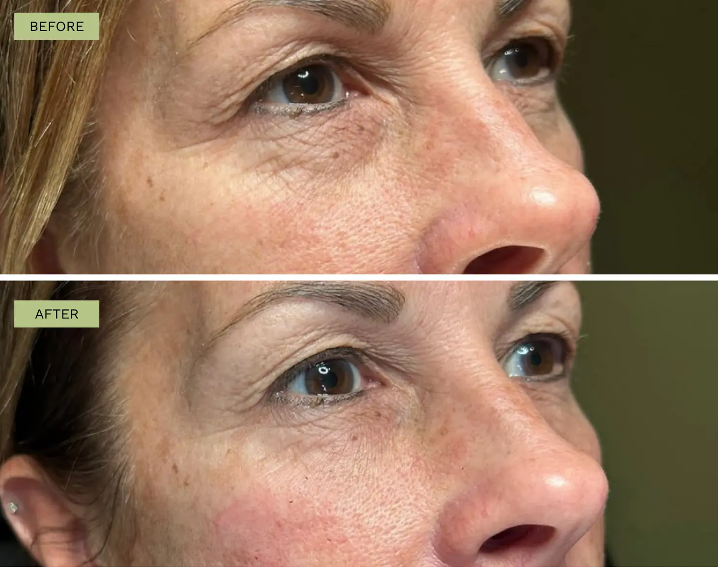 Elite Under Eye Filler with Belotero - Jeff Goldstein, PA-C