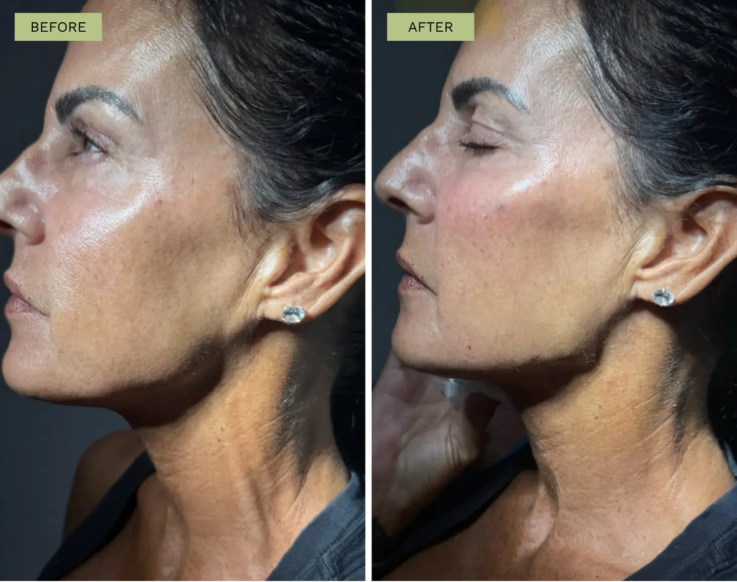 Elite Facial Balancing - Radiesse in Jawline, Cheeks, & Marionettes - Melanie Hartsell, APRN-C
