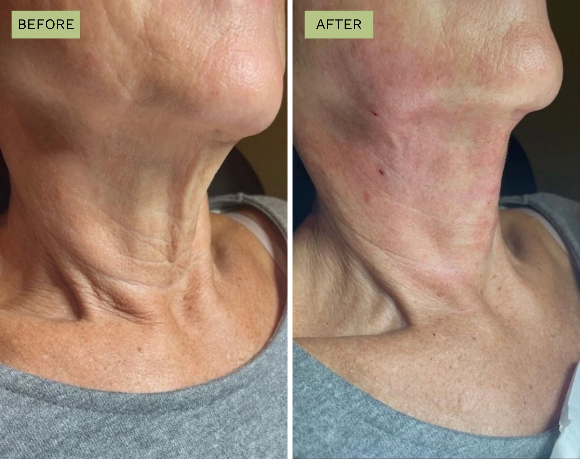 Neck Lift with PDO Thread