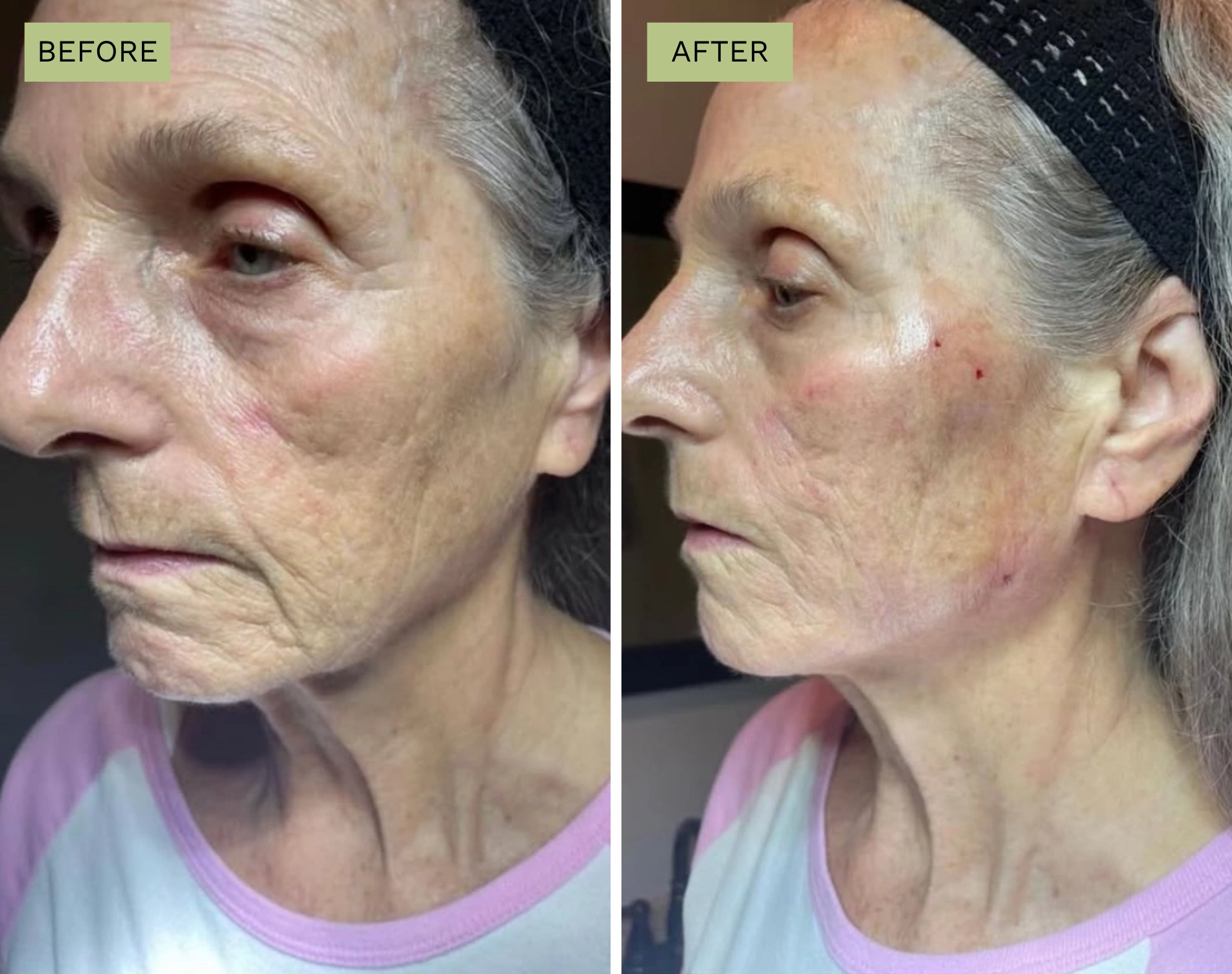 PDO Threads for Cheek and Jawline Lift