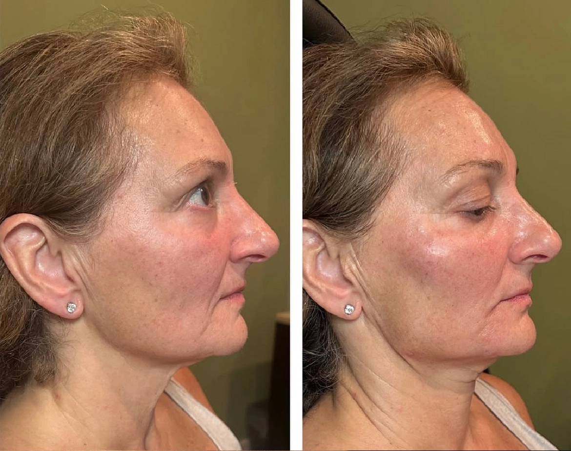 jaw-linesss.webp
