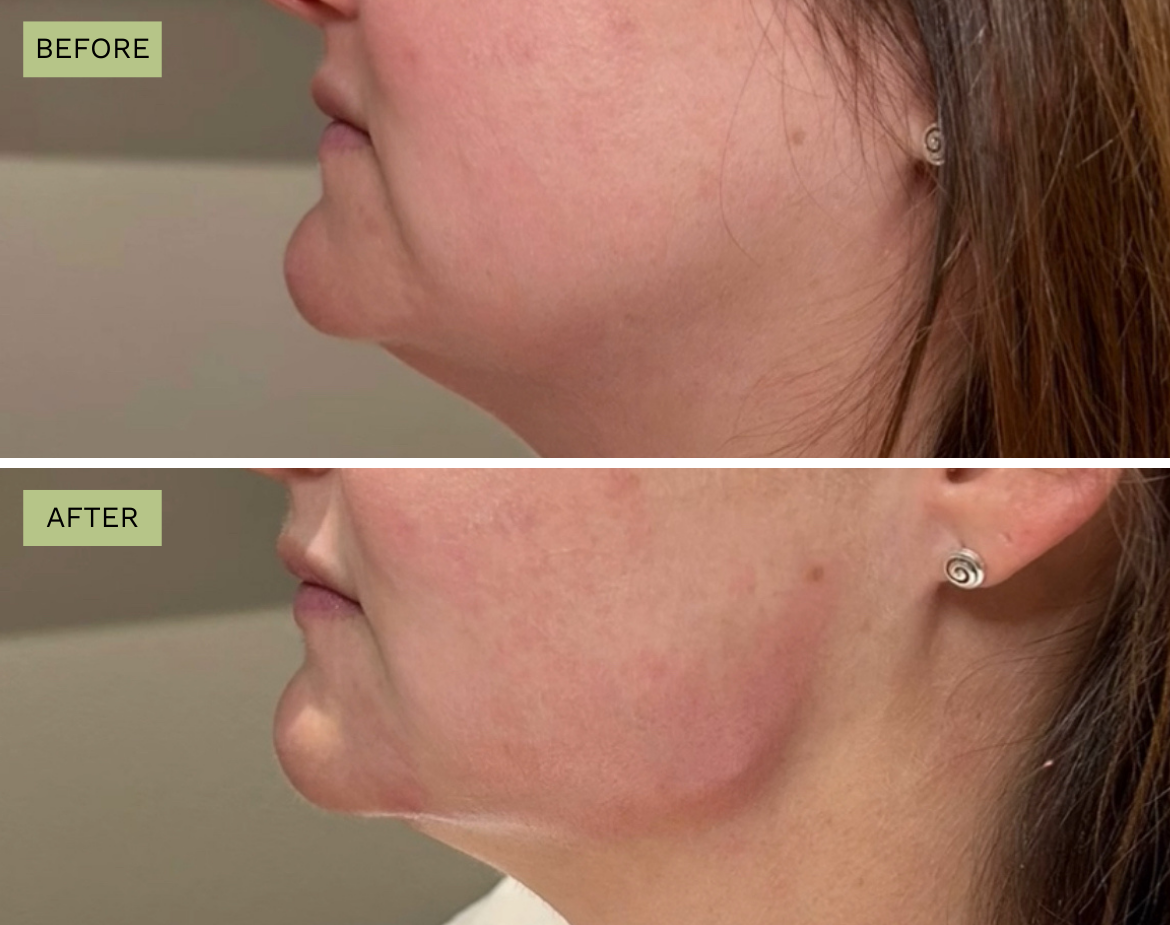 Elite Jawline – Jeff Goldstein, PA-C