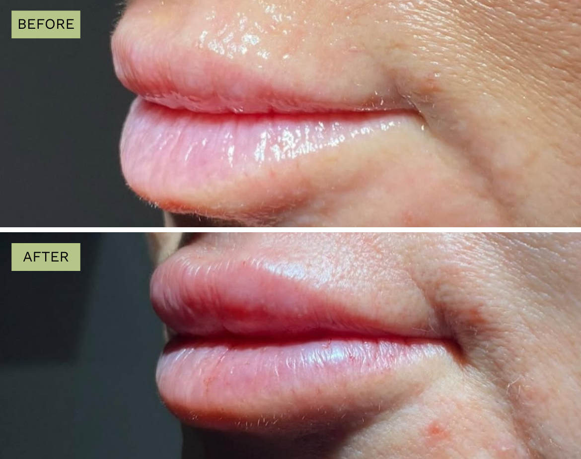 Elite Lips - Juvederm