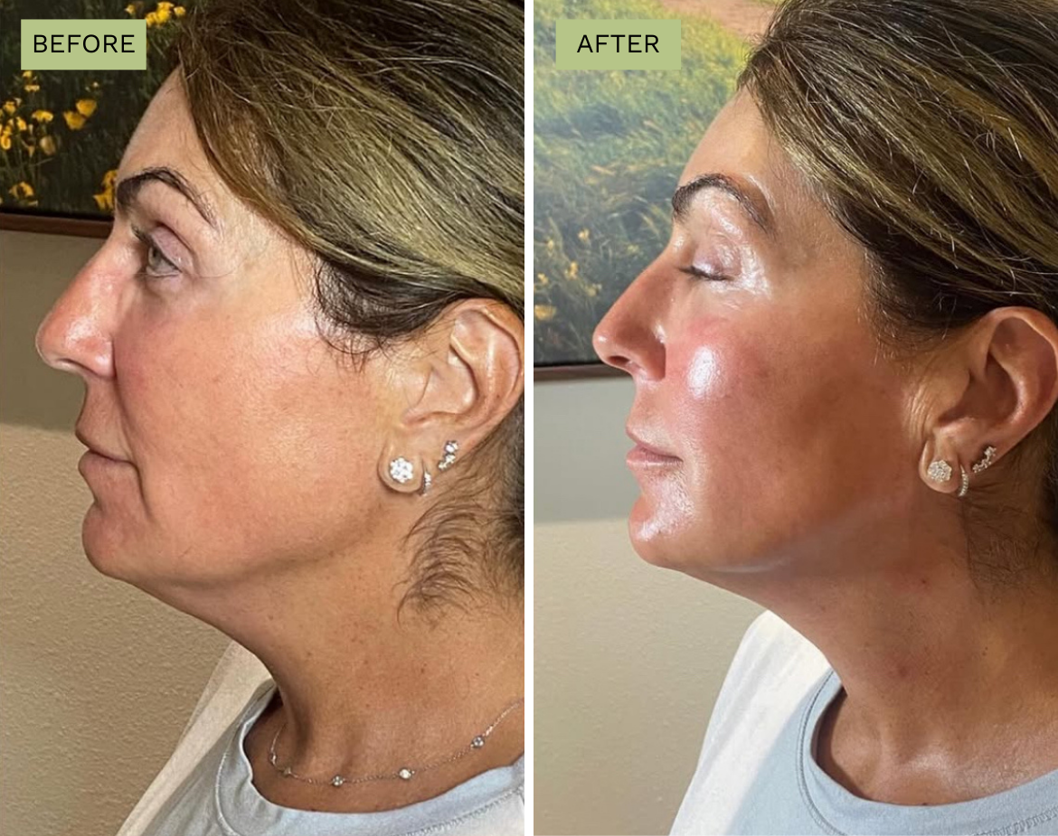 Elite Jawline - Radiesse