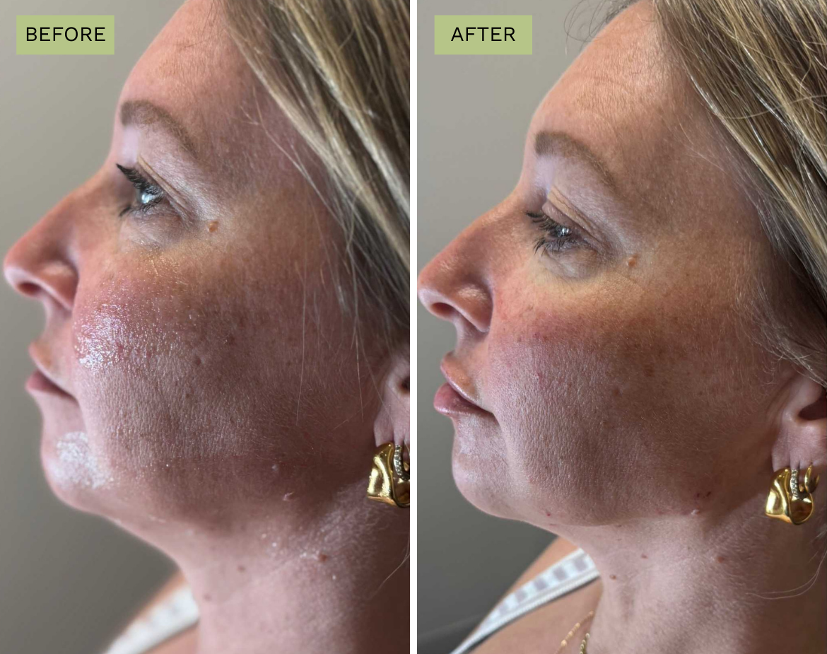 Elite Chin - Juvederm