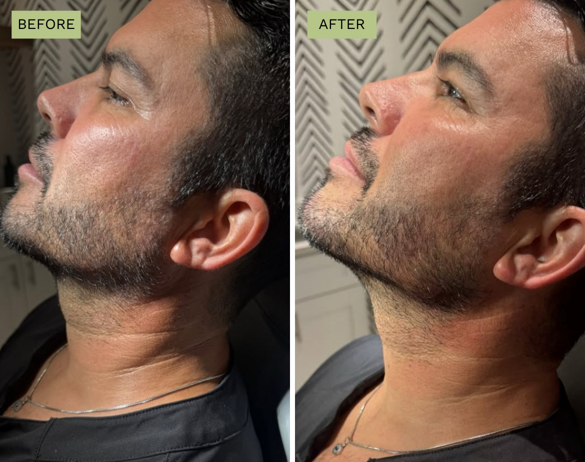 Elite Jawline - Radiesse