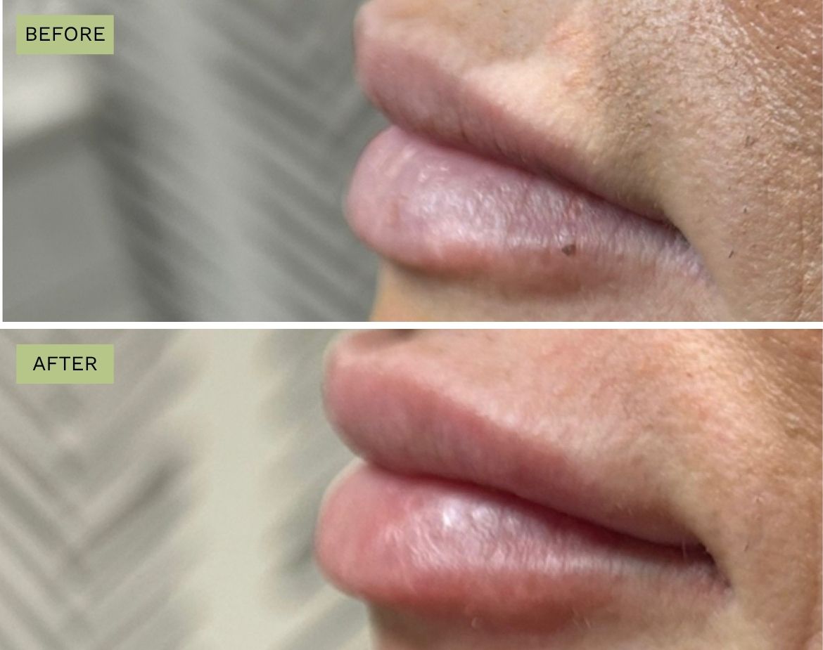 Elite Lips Filler with Juvederm